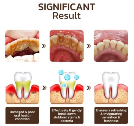 Dentifrice probiotique pour blanchir, éclaircir et éliminer les taches des dents