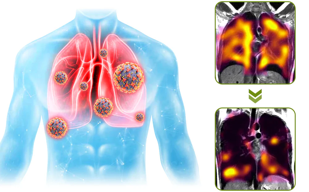 Natural Lung And Respiratory Support Spray