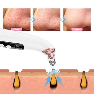 جهاز تنظيف المسام وإزالة الرؤوس السوداء