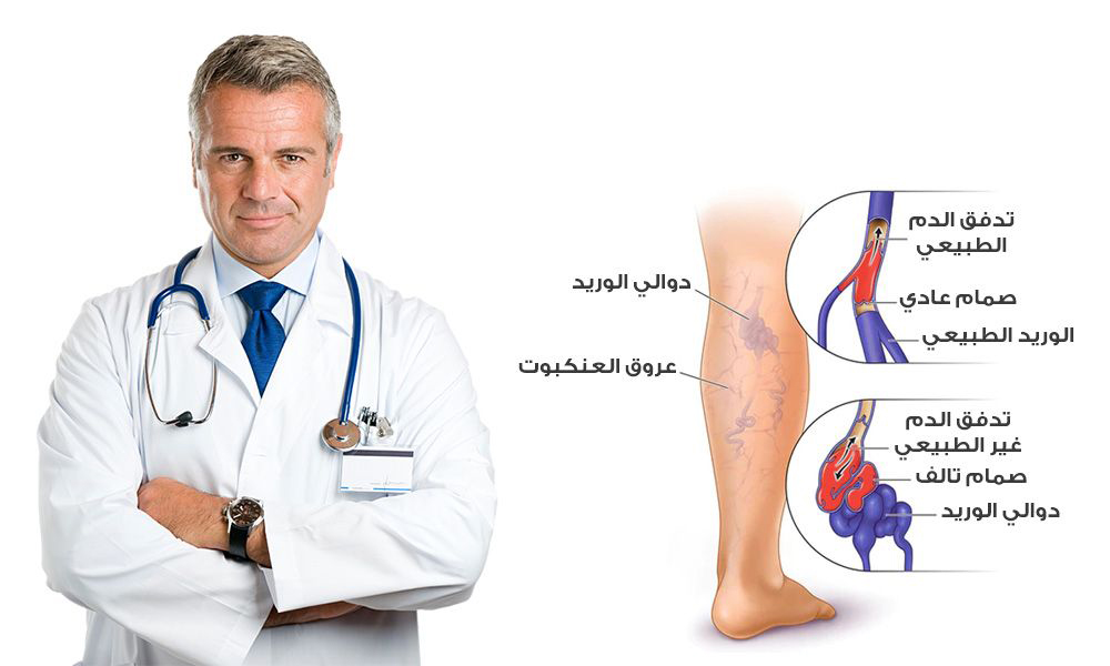 كريم محاربة الدوالي الوريدية