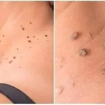 لاصقات ازالة الزوائد الجلدية