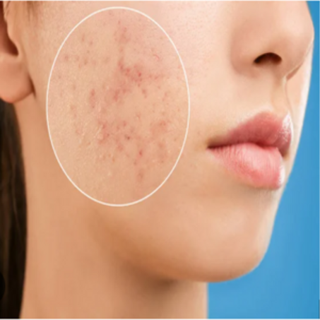 العناية بالبشرة الدهنية