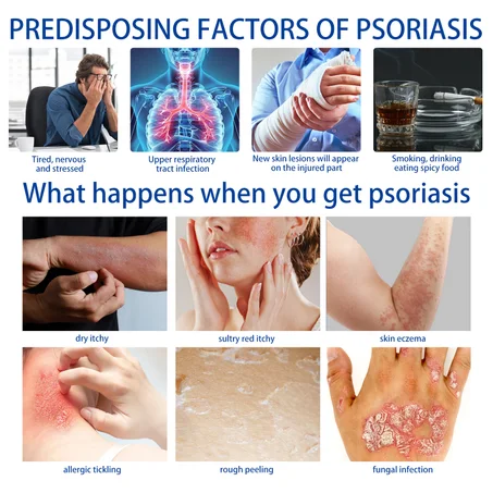 كريم التهاب الجلد والحكة والصدفية