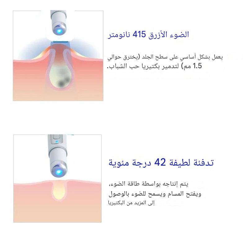 قلم ليزر ثوري لعلاج الدوالي والحبوب