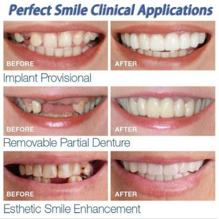 Membrane Teeth Whitening
