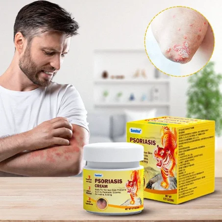 Tiger Psoriasis Cream (20g)