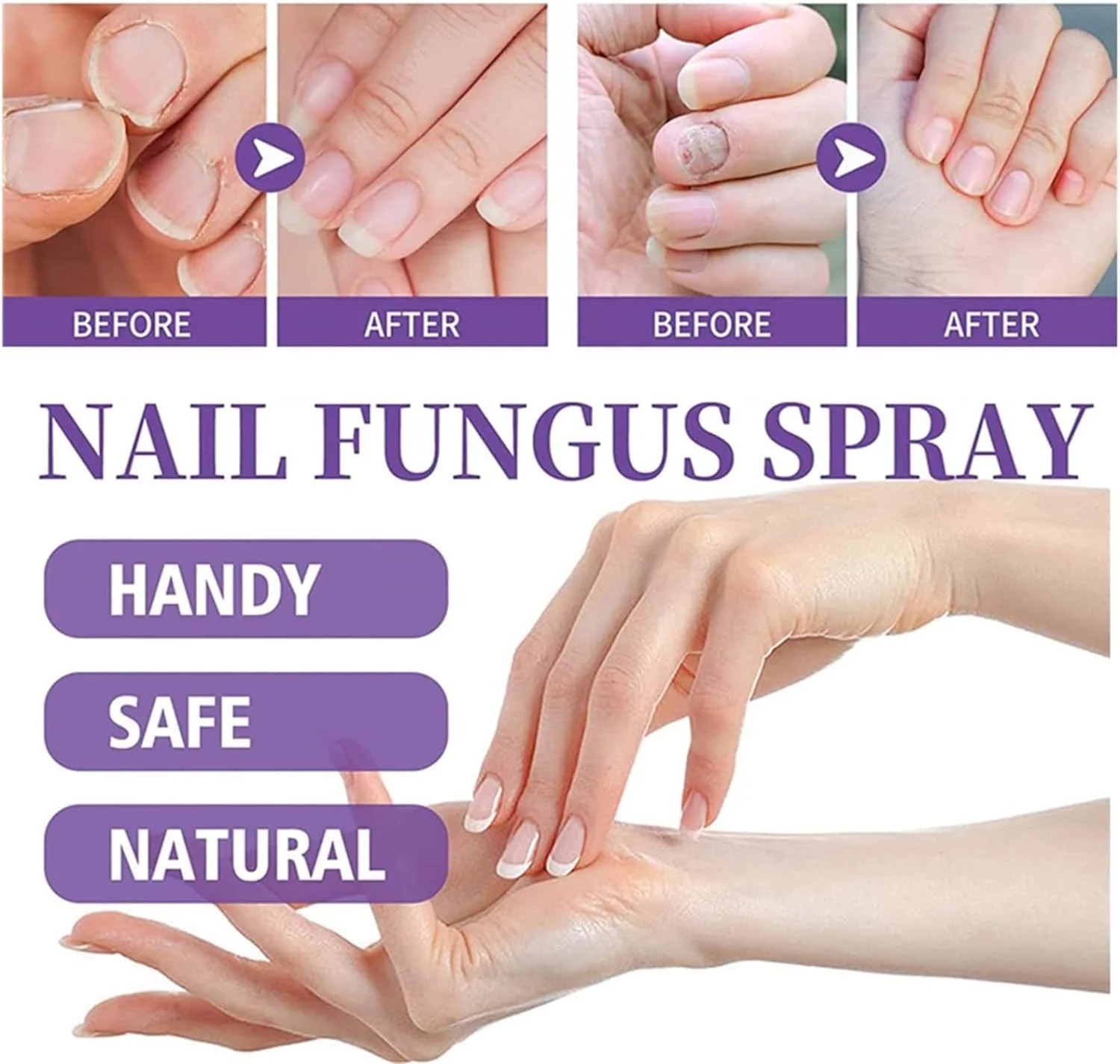 علاج الاظافر الفطري | محلول اظافر مضاد للميكروبات 30 مل | يقتل الفطريات والبكتيريا والفيروسات  Spray Mycose Des Ongles