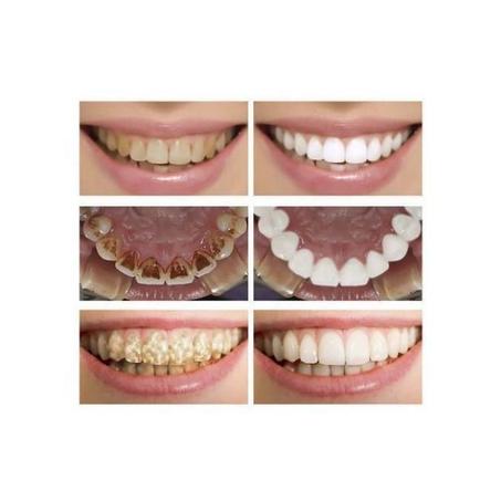 جوهر تبييض الأسنان