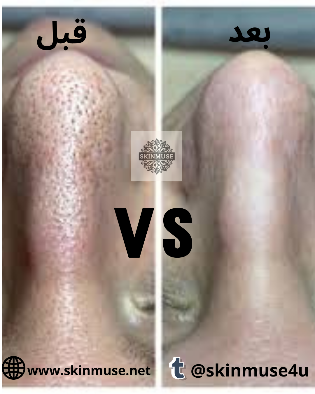 Blackhead Vacuum, Facial Cleanser