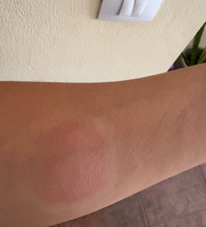 Anti-Cellulite Suction Cup – Slimming Infrared Massage