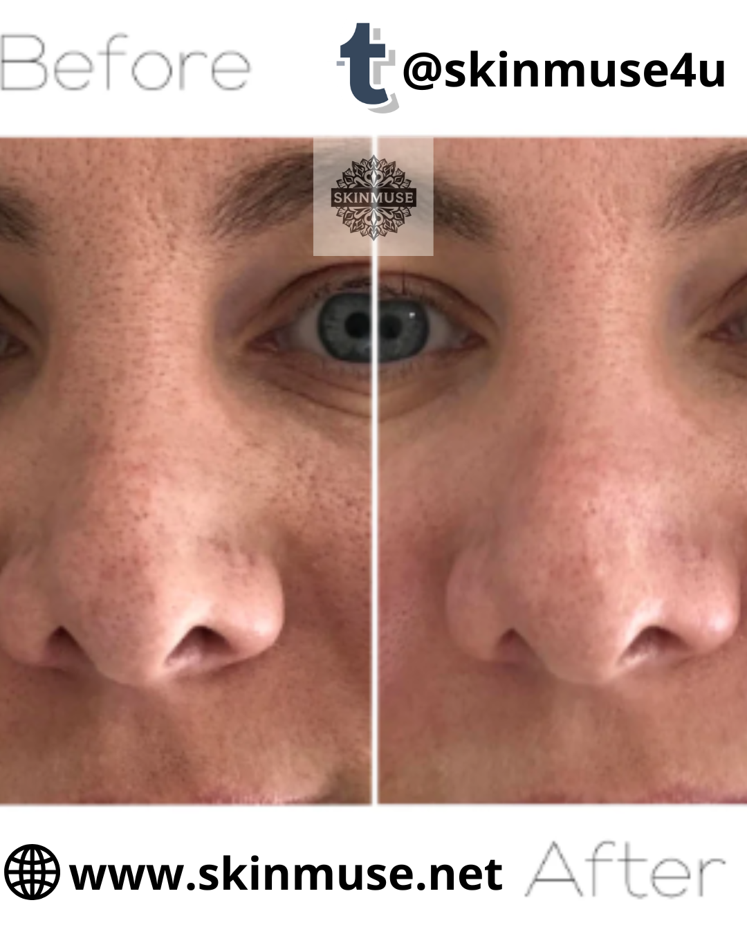 Blackhead Vacuum, Facial Cleanser