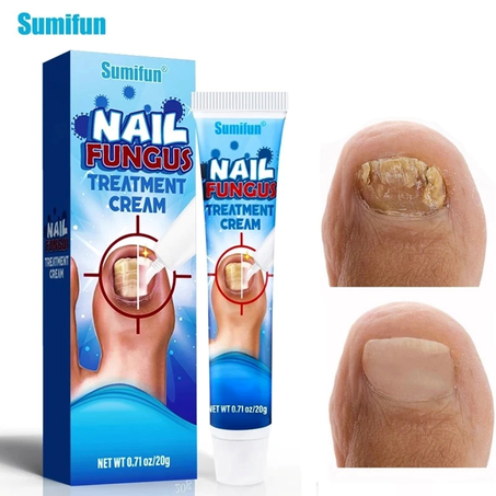 كريم Nail fungus لعلاج فطريات الأظافر