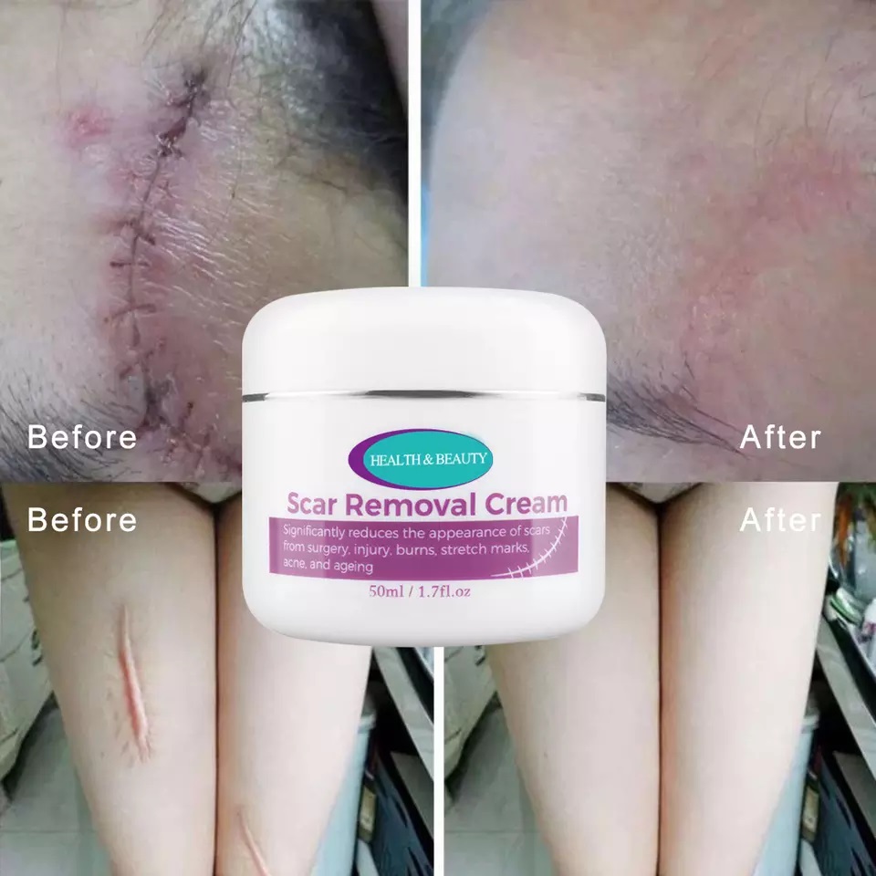 Magic scar removal cream