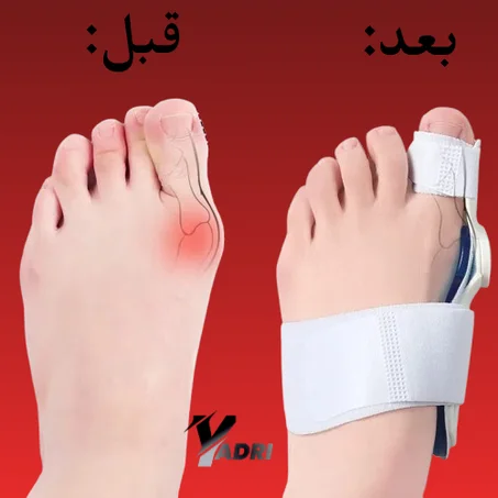 مصحح أصبع القدم الكبير ضابط الإبهام وعظام الأصبع