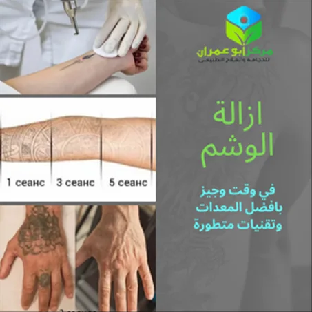 ازالة الوشم