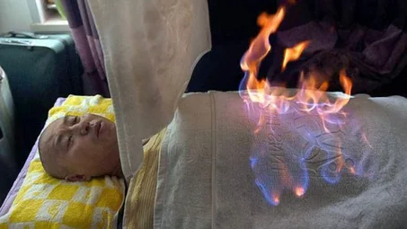 العلاج بالفوطة النارية