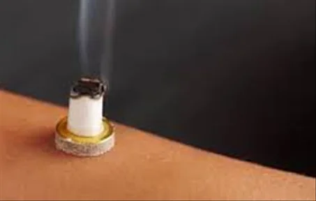 العلاج بالموكسا