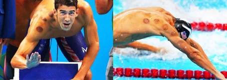 الحجامة الرياضية