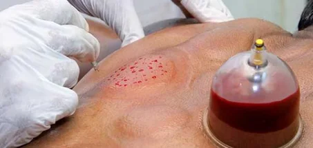 الحجامة العلاجية