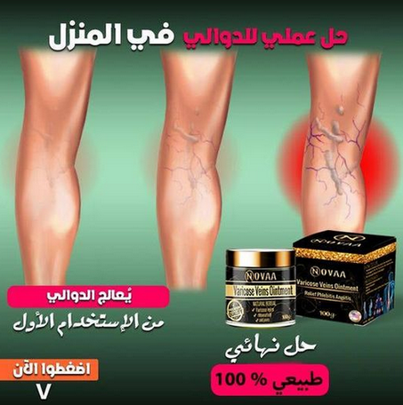 علاج الدوالي