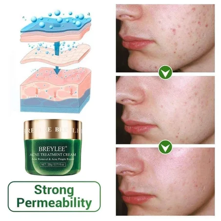 Acne Treatment Cream