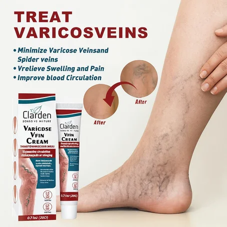كريم الدوالي - Cream Varicose Veins