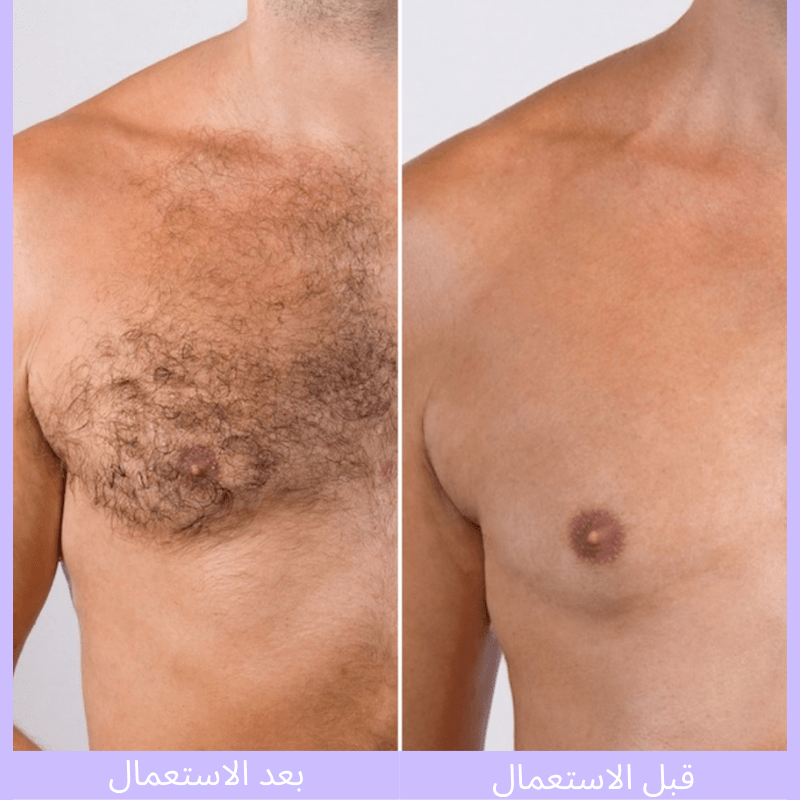 ماجيك كريستال لإزالة الشعر بتقنية نانو غير مؤلم