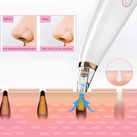 جهاز لشفط و إزالة الرؤوس السوداء