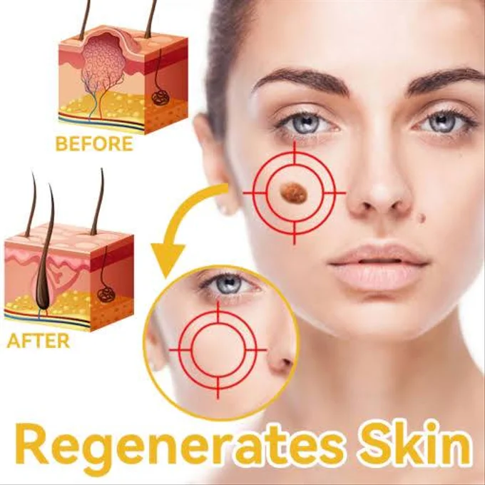 بخاخ سم النحل لإزالة الثآليل و الزوائد الجلدية بأمان😍