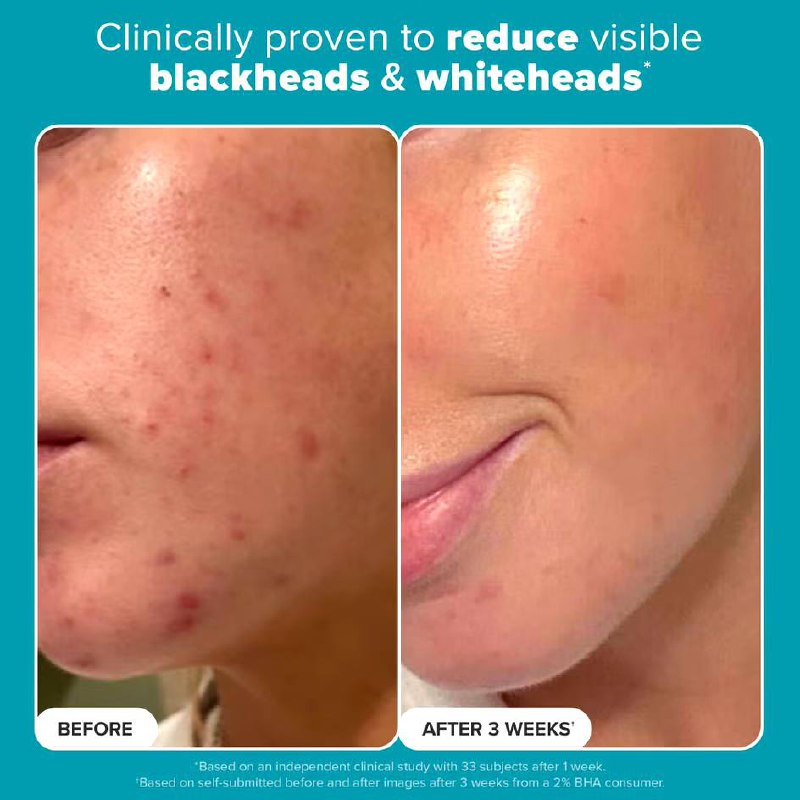 Paula’s Choice Skin Perfecting 2% BHA Exfoliant Toner