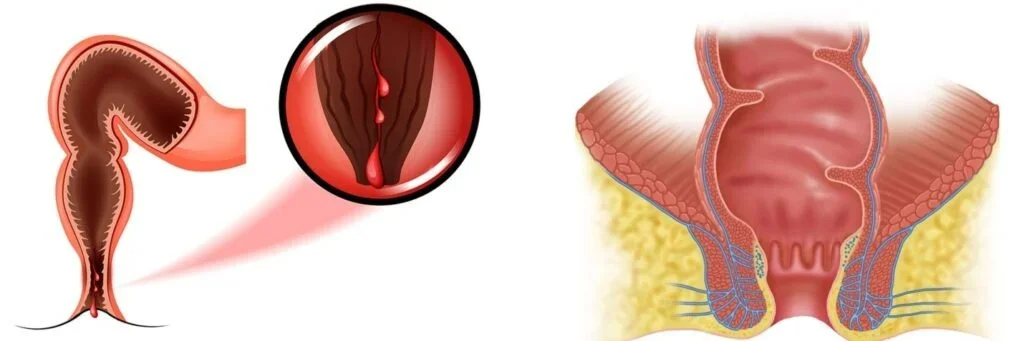 Hemorelief