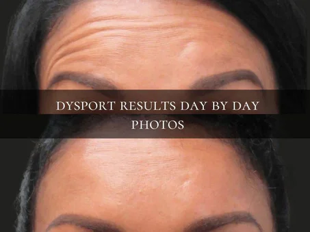 Toxine botulinique type A  500 U Speywood