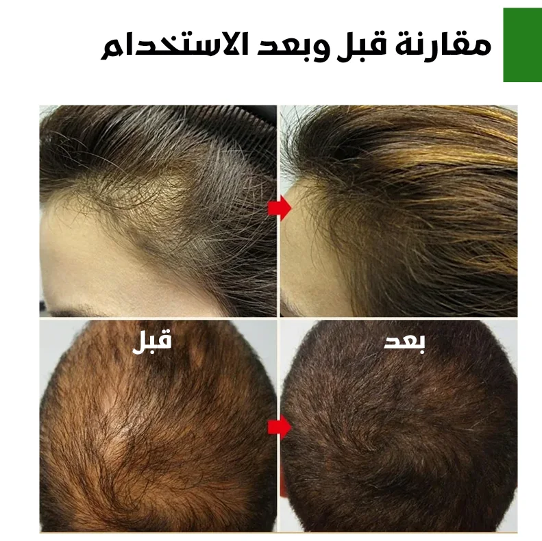 بخاخ جنجر للنمو الشعر