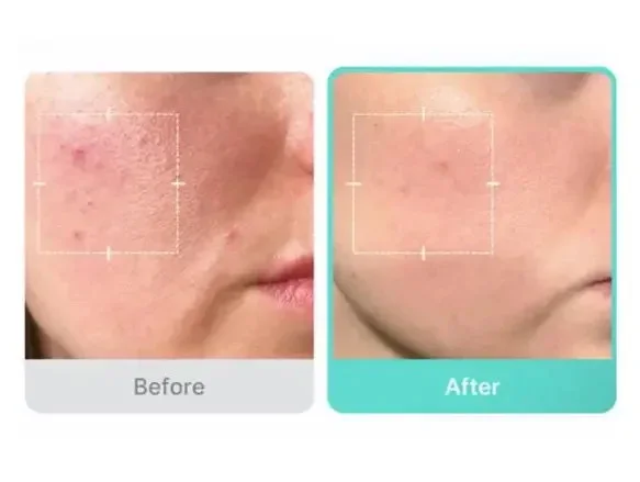 سيروم ميديكوب المهدئ بحمض الأزيليك 16 بي بي، 30 مل Medicube Azelaic Acid 16% Soothing Serum –30ml