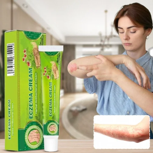 كريم  فعال يقضي على الصدفية و الاكزيما و الحكة