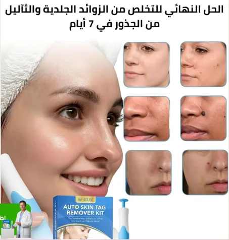 الحل لزوائد جلدية