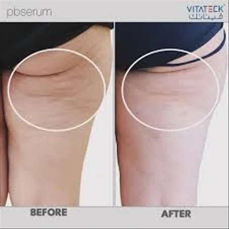 جهاز إزالة السيلوليت