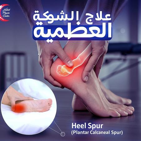 بخاخ طبيعي لعلاج مسمار الكعب