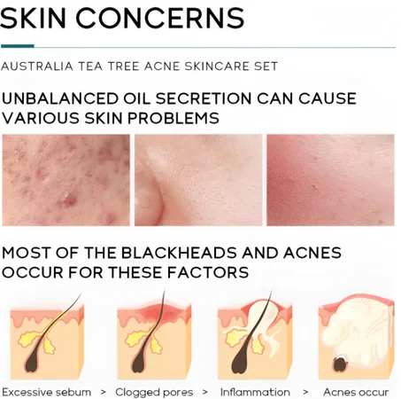 منتج عناية بالبشرة بخلاصة شجرة الشاي للفتيات المراهقات والنساء، طقم يشمل غسول وجه وتونر وسيروم وكريم للوجه وجل، مجموعة عناية متكاملة للتحكم في الزيوت وعلاج حب الشباب لجميع الأنواع من لايكو (5