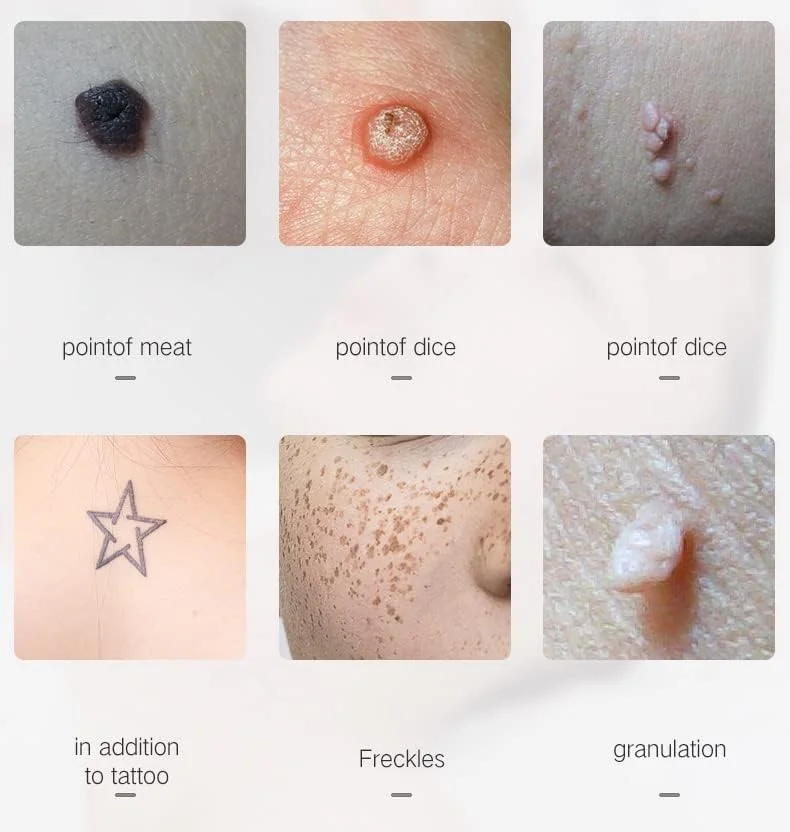 • قلم ازالة الشامة بالبلازما