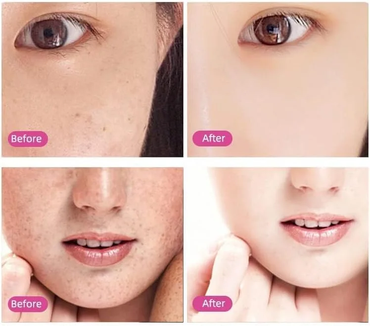 • قلم ازالة الشامة بالبلازما