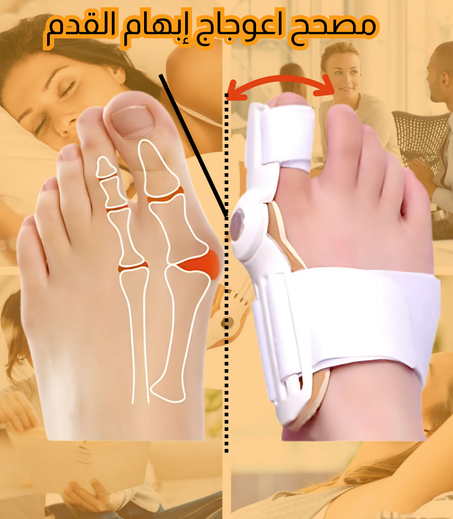 الحل الأمثل لنحراف إبهام القدم