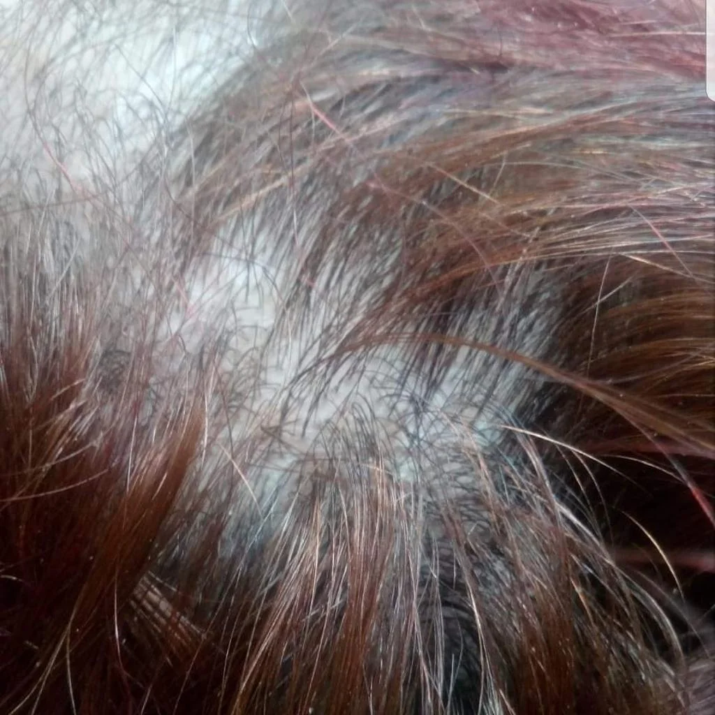 Pack Anti Hair Loss