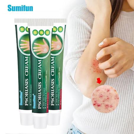 كريم الصدفية الفائق علاج مشاكل الصدفية والجلد. علاج الأعراض الصدفية   وتجديد الجلد للحصول على نتائج دائمة...