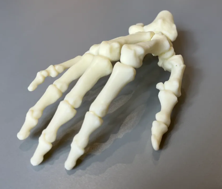 Metacarpal Fracture Case