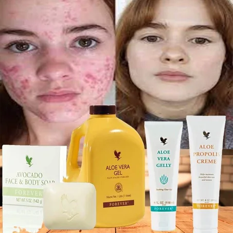 مجموعة حب الشباب من فوريفر