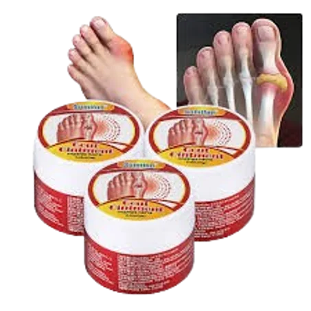 مرهم لتخفيف آلام النقرس