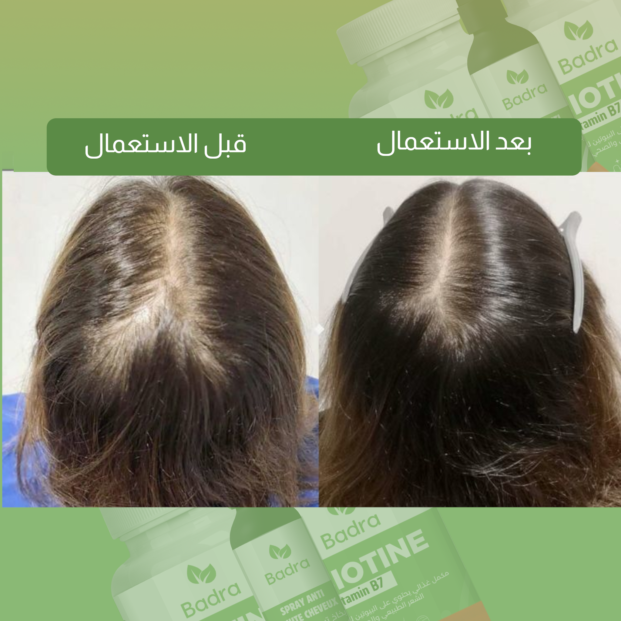 باقة متكاملة لمشكل تساقط الشعر