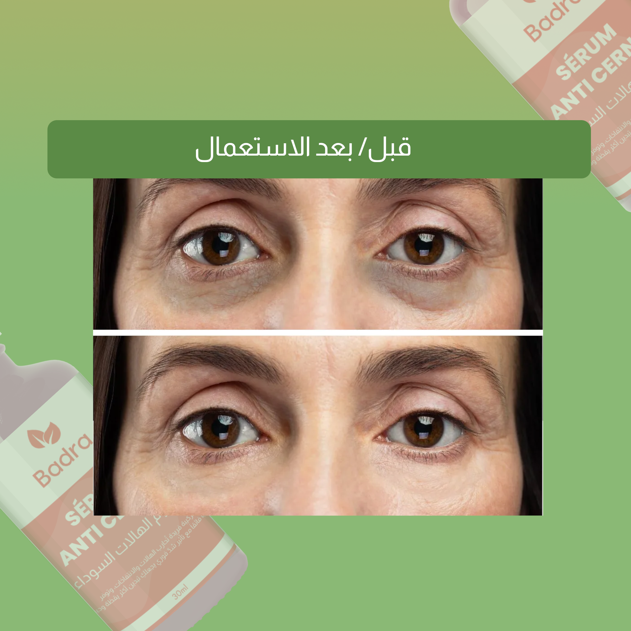 باقة علاج  الكلف و الهالات السوداء تحت العين