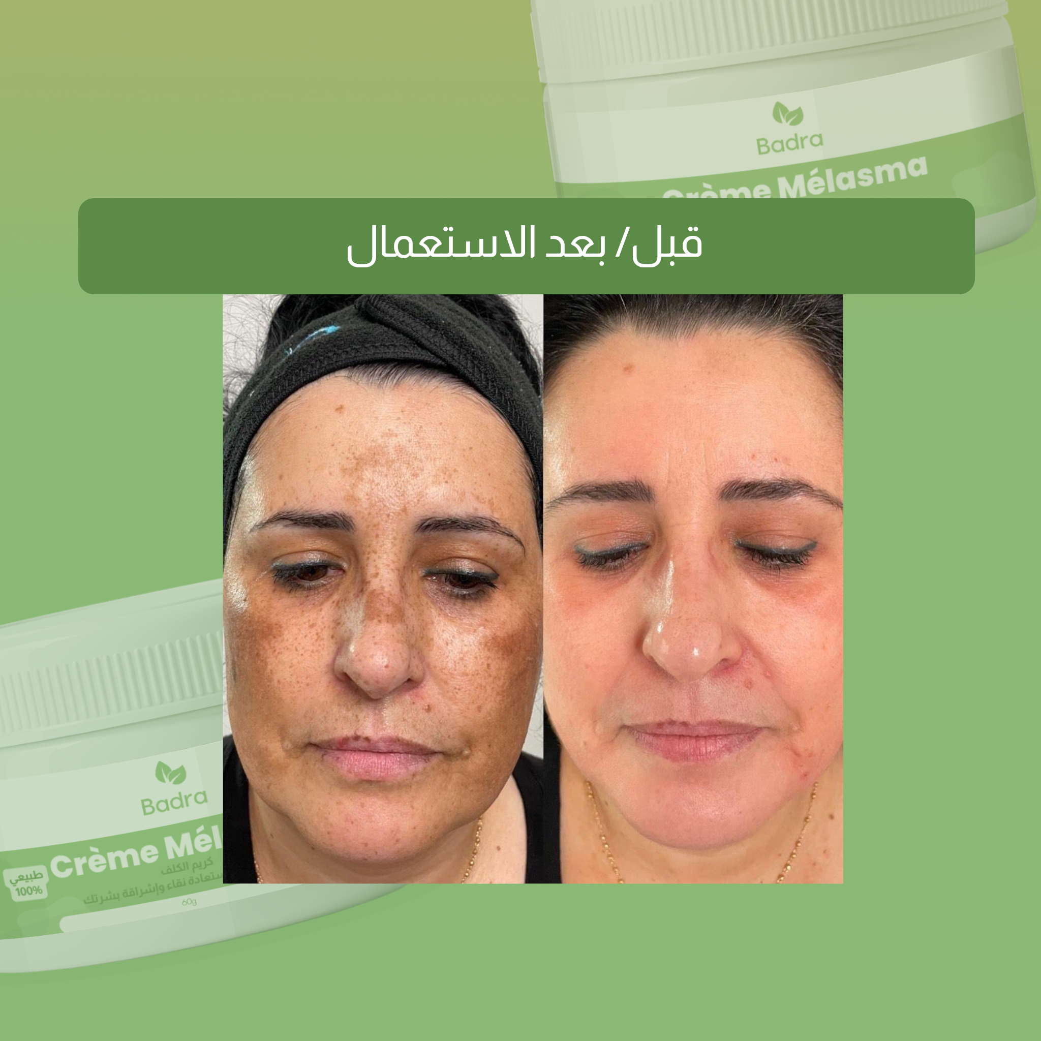 باقة علاج  الكلف و الهالات السوداء تحت العين